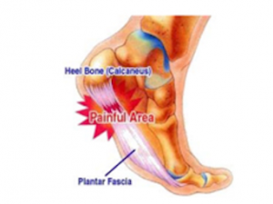 Plantar fasciitis – The stubborn pain that won’t go away!