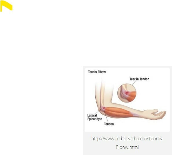 Tennis Elbow Burnaby Physio