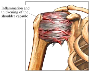 Frozen Shoulder