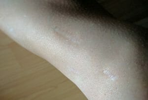 Scar Tissue Management