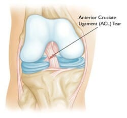 What Happens After ACL Reconstruction