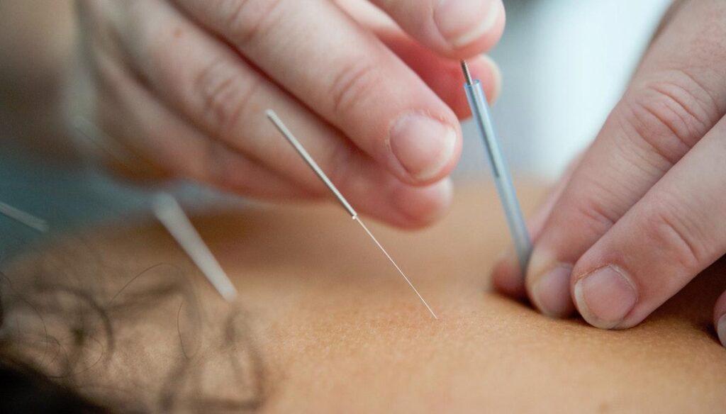 Acupuncture for Mental Health Burnaby BC